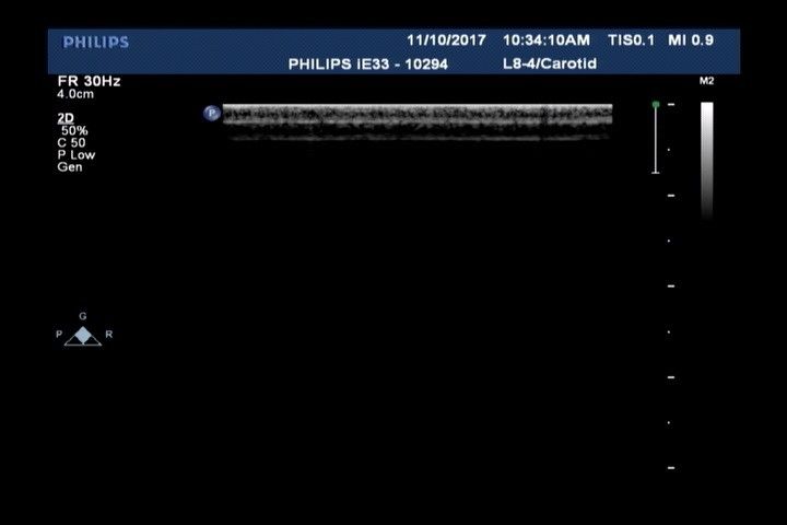 Philips L8-4 Linear Transducer Ultrasound Probe DIAGNOSTIC ULTRASOUND MACHINES FOR SALE