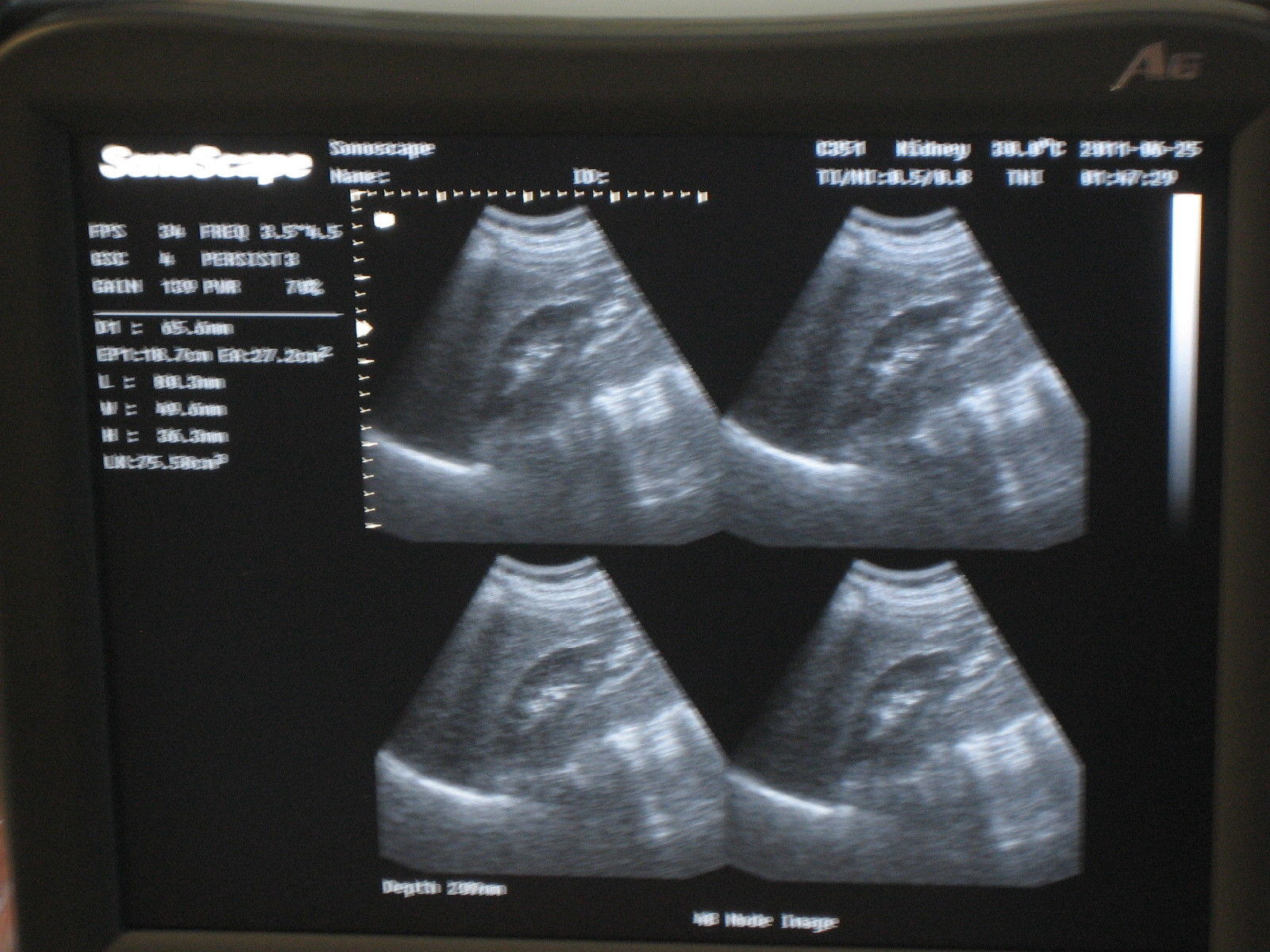 Ultrasound SonoScape A6 B/W with convex and Endovaginal DIAGNOSTIC ULTRASOUND MACHINES FOR SALE