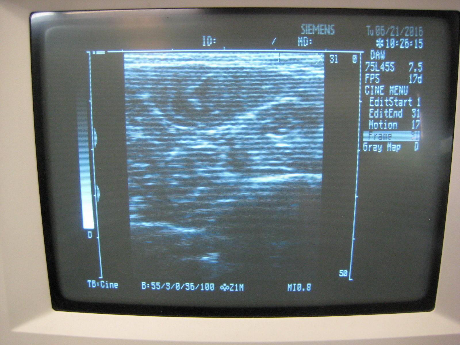 Siemens Sonoline Prima Ultrasound with Linear probe and printer. Guaranteed DIAGNOSTIC ULTRASOUND MACHINES FOR SALE