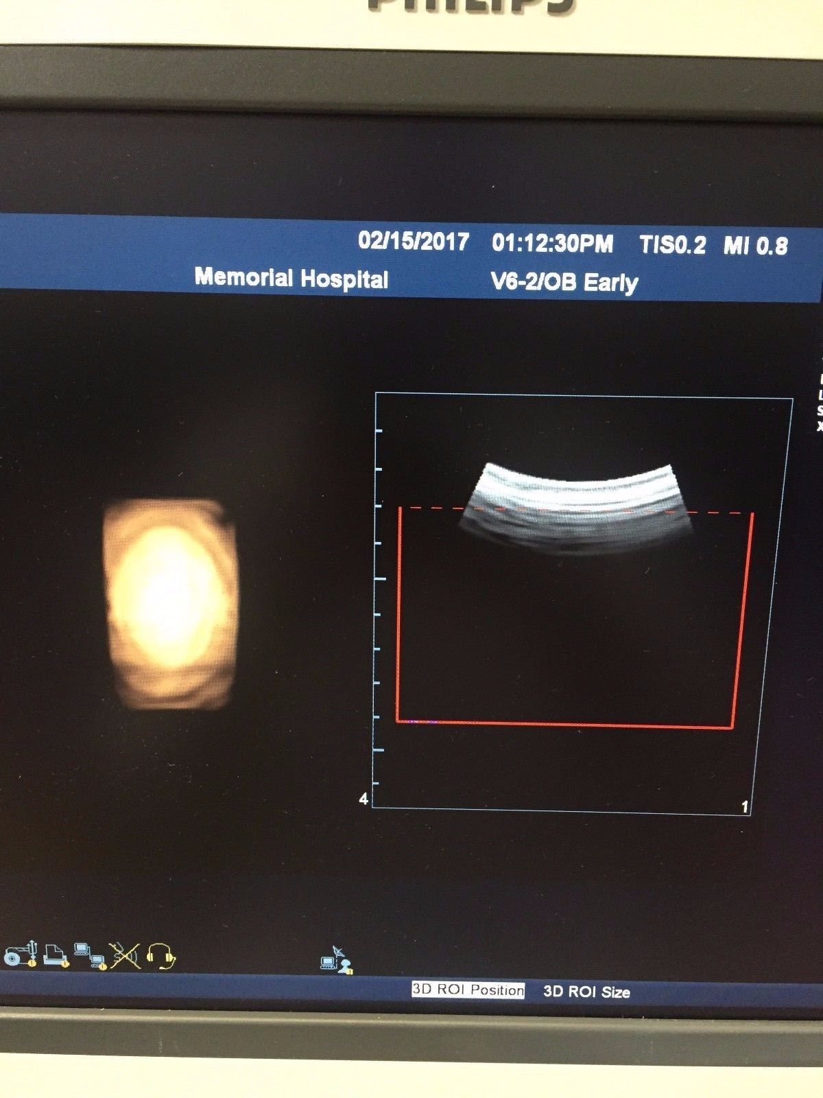 Philips V6-2 Curved Volume Array Ultrasound Transducer for Philips iU22 DIAGNOSTIC ULTRASOUND MACHINES FOR SALE