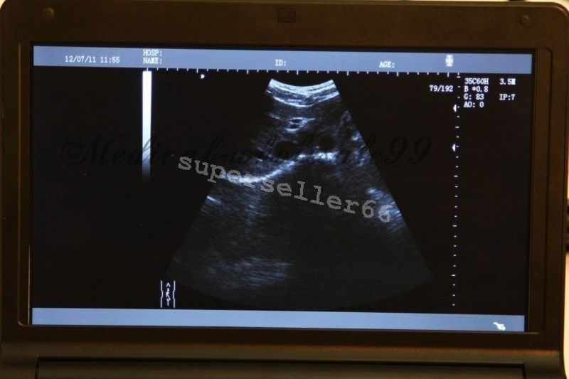 Laptop LCD Ultrasound Scanner Diagnostic Ultrasonic Machine +Convex Linear Probe 190891743886 DIAGNOSTIC ULTRASOUND MACHINES FOR SALE