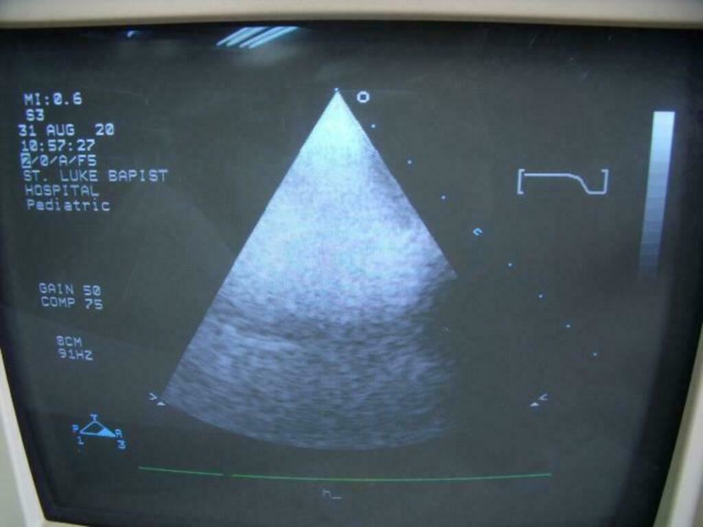 Philips 21311A S3 Ultrasound Probe | PR5323 DIAGNOSTIC ULTRASOUND MACHINES FOR SALE