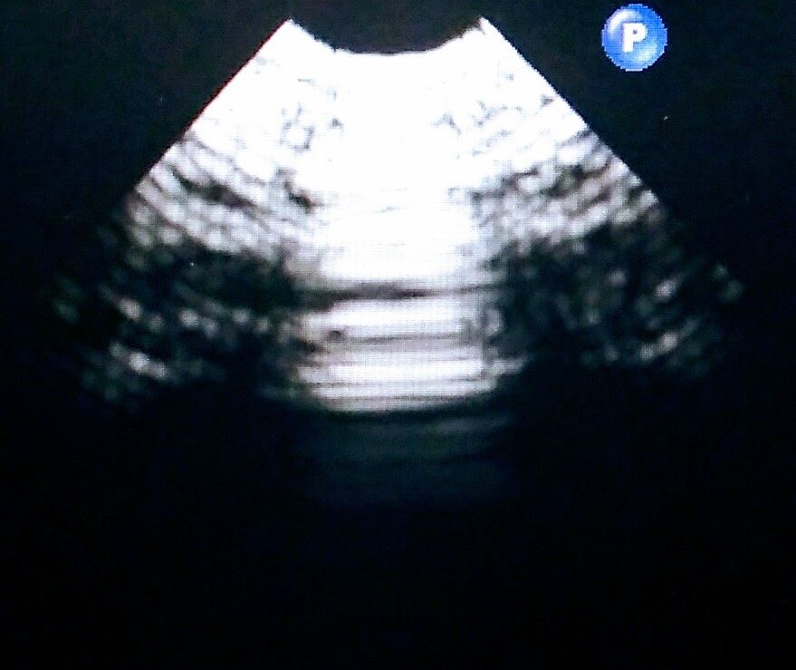 monitor capturing ultrasound