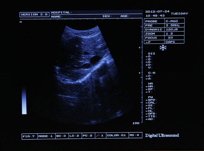 Full Digital Portable Ultrasound Scanner w multi-frequency 7.5 linear Probe w 3D DIAGNOSTIC ULTRASOUND MACHINES FOR SALE