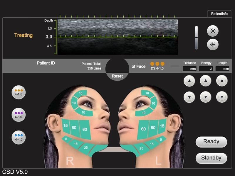 HIFU High Intensity Focused Ultrasound Ultrasonic Hifu Machine Face Lifting DIAGNOSTIC ULTRASOUND MACHINES FOR SALE