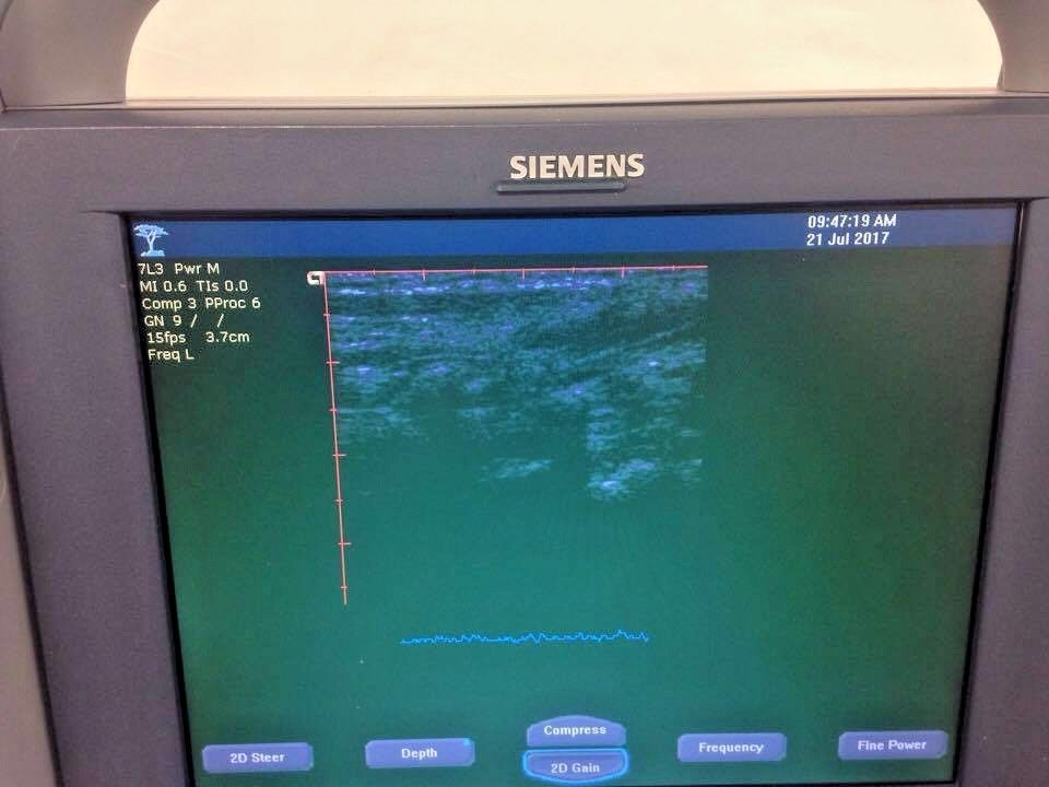 Siemens Acuson Plus Rev 20 Ultrasound Machine. BIOMED Certified & Warranty DIAGNOSTIC ULTRASOUND MACHINES FOR SALE