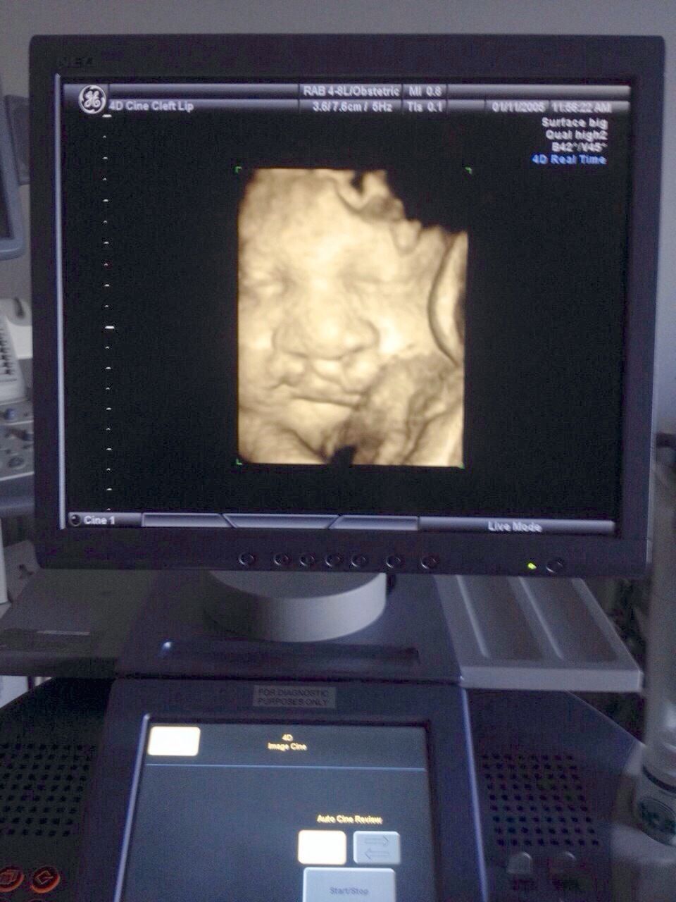 a ultrasound computer screen with a picture of a person's stomach