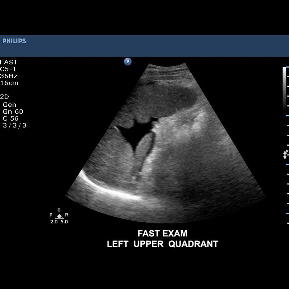 Philips CX50 Portable Ultrasound System with S5-1 Cardiac Sector Transducer DIAGNOSTIC ULTRASOUND MACHINES FOR SALE