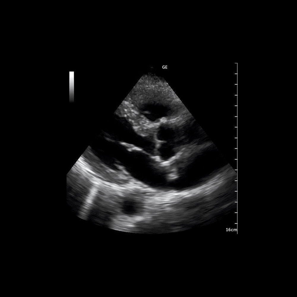 a black and white image of ultrasound