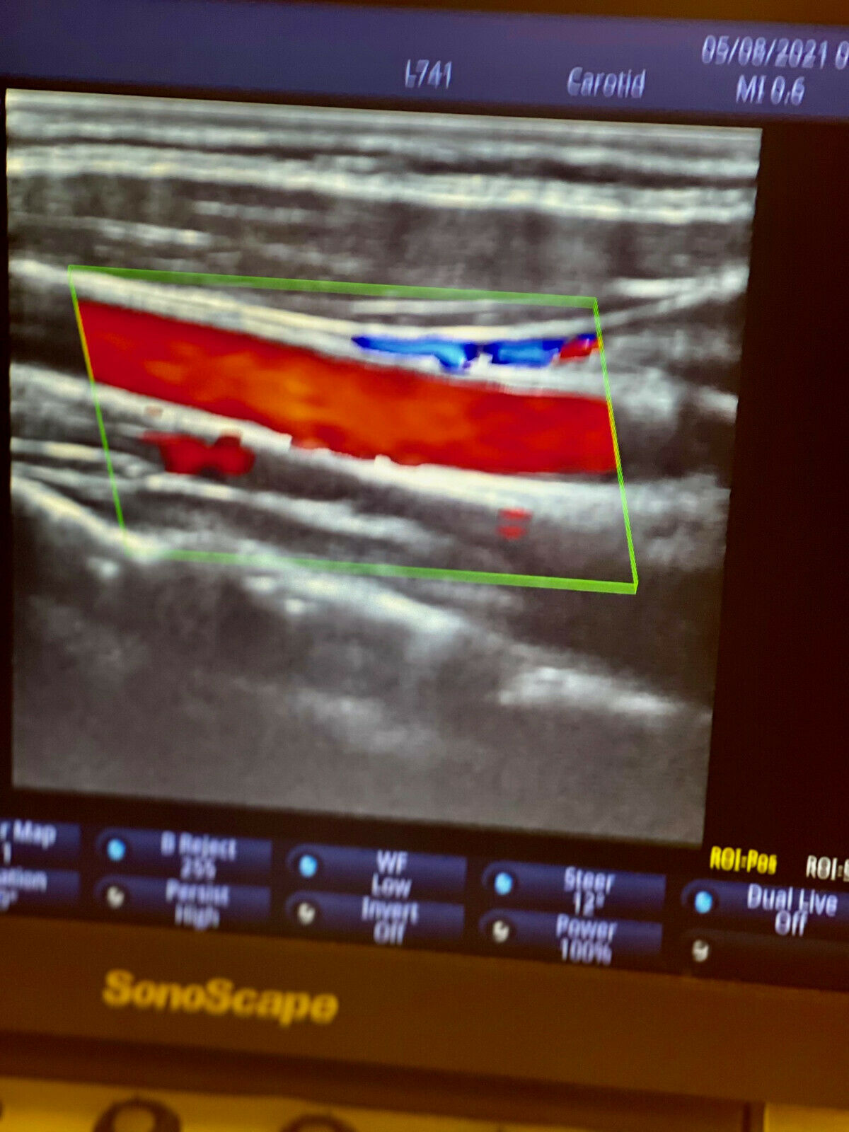 Sonoscape EXP Ultrasound Used, in Excellent condition, only used for 6 Months DIAGNOSTIC ULTRASOUND MACHINES FOR SALE