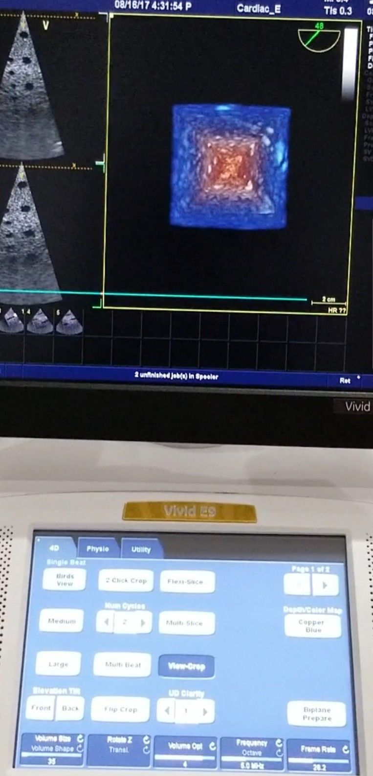 a ultrasound computer screen with a image in the center
