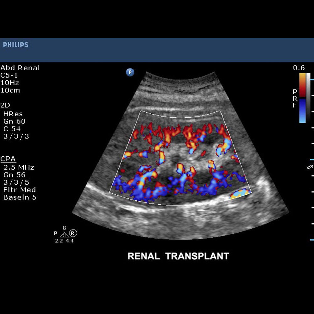Philips CX50 Portable Ultrasound System with S5-1 Cardiac Sector Transducer DIAGNOSTIC ULTRASOUND MACHINES FOR SALE