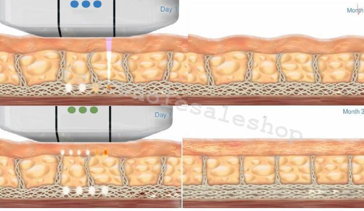 HIFU Facail Skin Tightening Anti Aging High Intensity Focused Ultrasound Machine DIAGNOSTIC ULTRASOUND MACHINES FOR SALE