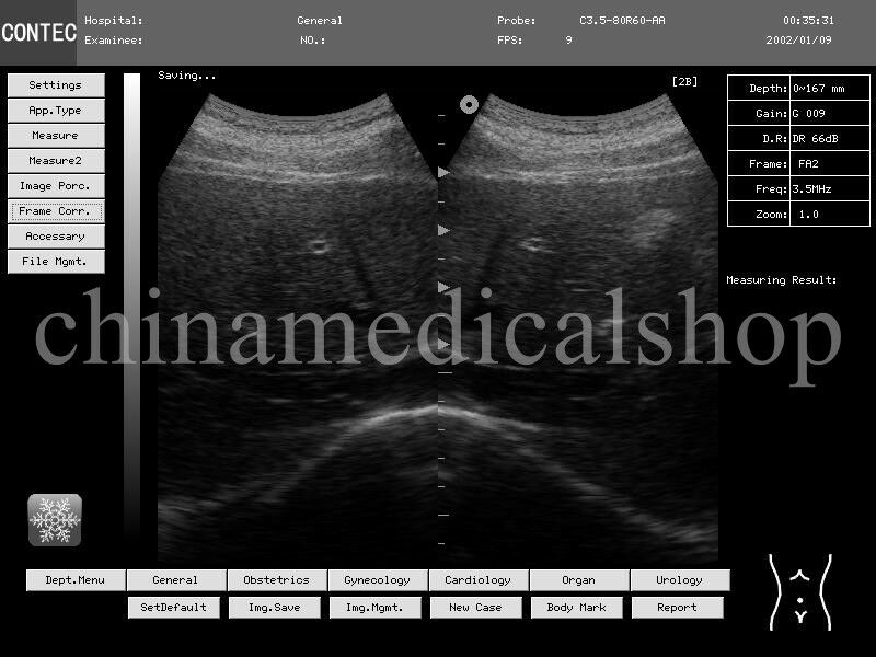 Portable Laptop Ultrasound Scanner Machine 2 Probes Digital Diagnostic System 658126901772 DIAGNOSTIC ULTRASOUND MACHINES FOR SALE