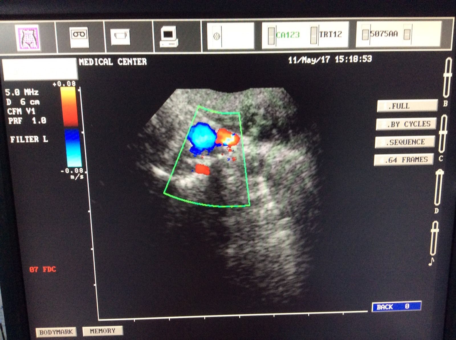 Esaote Biosound, MyLab ultrasound CA123 micro convex probe DIAGNOSTIC ULTRASOUND MACHINES FOR SALE