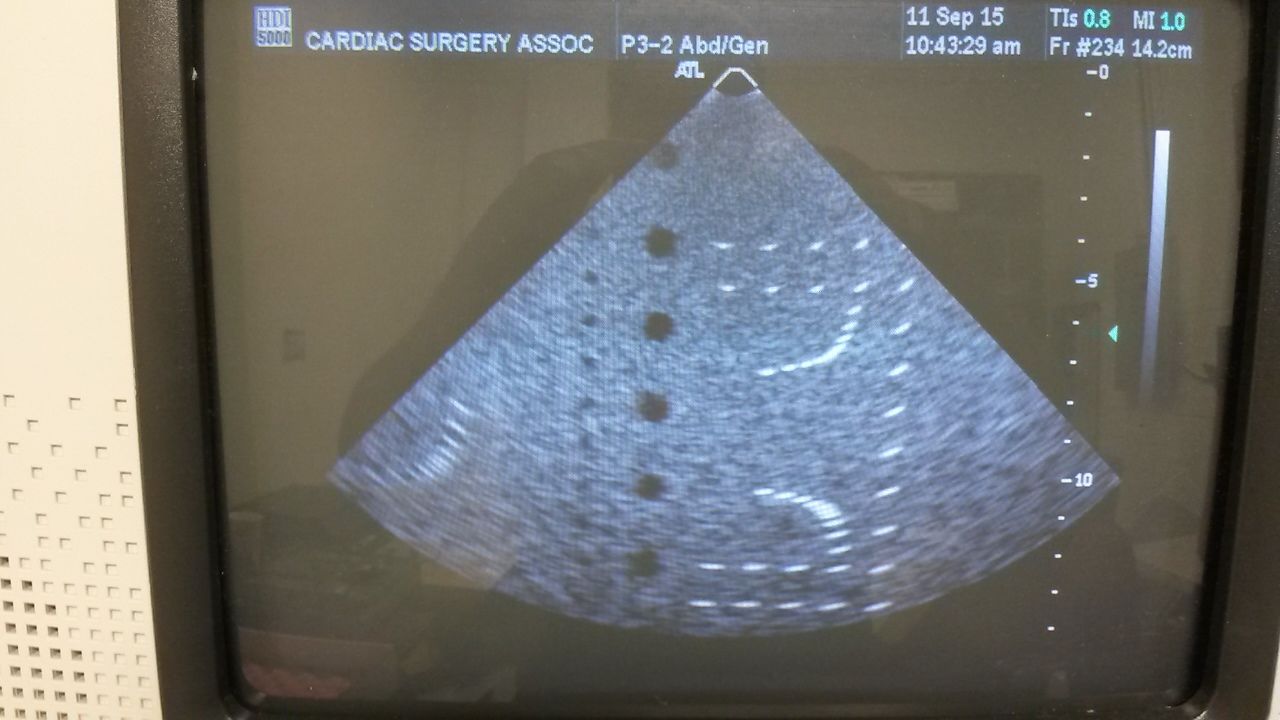 ATL P3-2 cardiac ultrasound probe DIAGNOSTIC ULTRASOUND MACHINES FOR SALE